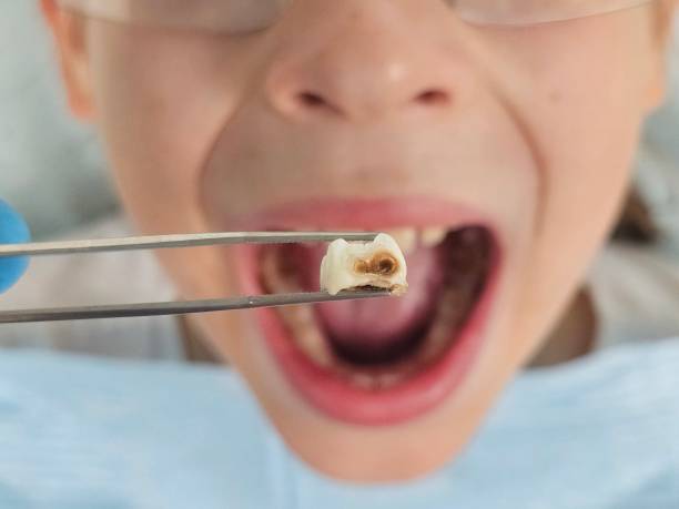 Best Emergency Tooth Extraction in Clay, KY