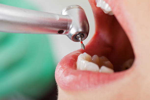 Best Emergency Dental Care for Broken or Chipped Teeth in Clay, KY